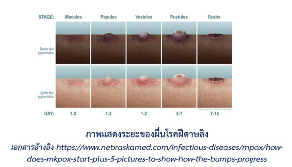 แพทย์รามาฯ แนะป้องกันฝีดาษลิง พร้อมช่วยเหลือผู้ป่วยยากไร้