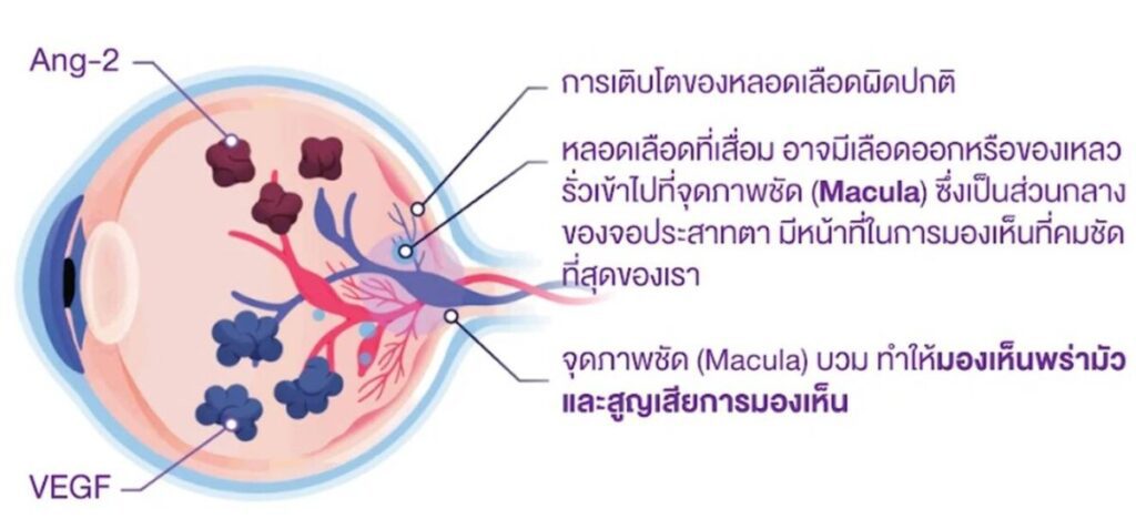 โรชเตือนภัย! 1 ใน 5 ผู้สูงวัยไทยละเลยตรวจตา เสี่ยงจอตาเสื่อม