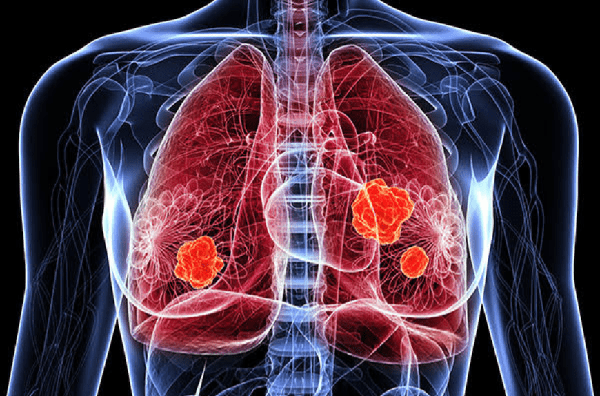 ในข่าวนี้มีข้อมูลสำคัญที่ควรเน้นคือ: ปี 2568: มะเร็งปอดเป็นสาเหตุการเสียชีวิตอันดับ 1 คาดการณ์ว่าจะมีผู้เสียชีวิต 41 คนต่อวัน และผู้ป่วยรายใหม่ 57 คนต่อวัน หญิงไทยไม่สูบบุหรี่เป็นมะเร็งปอดสูงเป็นอันดับ 2 ของโลก: เป็นข้อมูลที่น่าตกใจและชี้ให้เห็นถึงปัจจัยเสี่ยงอื่นๆ นอกจากการสูบบุหรี่ การเร่งผลักดันนโยบายเพิ่มการเข้าถึงนวัตกรรมการรักษาและการคัดกรอง: ภาครัฐและภาคีสุขภาพกำลังทำงานร่วมกันเพื่อแก้ไขปัญหานี้ การทบทวนเกณฑ์ "ความคุ้มค่า": เพื่อให้ผู้ป่วยเข้าถึงการรักษาที่ดีที่สุด การคัดกรองเชิงรุก (Stage Shift): เป้าหมายคือการตรวจพบโรคในระยะเริ่มต้น (ระยะที่ 1) แทนที่จะเป็นระยะลุกลาม (ระยะที่ 4) เพื่อเพิ่มโอกาสในการรักษาและลดค่าใช้จ่าย ความก้าวหน้าในการรักษา: การผ่าตัดผ่านกล้อง, การฉายรังสีแบบแม่นยำ, ยามุ่งเป้า ความร่วมมือจากทุกภาคส่วน: การแก้ปัญหามะเร็งปอดอย่างยั่งยืนต้องอาศัยความร่วมมือจากภาครัฐ ภาคเอกชน และภาคประชาชน ภัยร้ายมะเร็งปอด: คาดการณ์ปี 2568 คร่าชีวิตคนไทย 41 คนต่อวัน – สธ. เร่งพลิกโฉมรับมือ