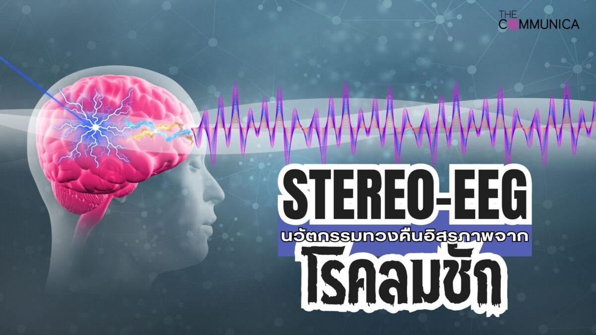 SEEG นวัตกรรมผ่าตัดรักษาโรคลมชัก